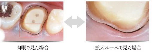 西葛西の歯医者、木村歯科医院で虫歯治療