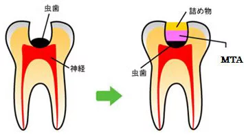 西葛西の歯医者、木村歯科医院で虫歯治療