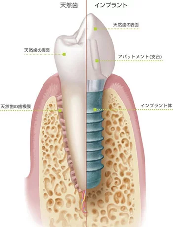 西葛西の歯医者、木村歯科医院のインプラント治療