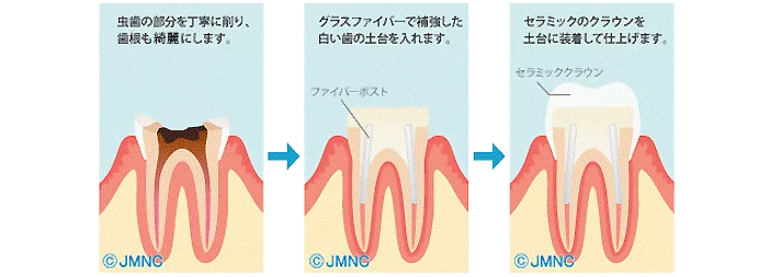 西葛西の歯医者、木村歯科医院の精密根管治療