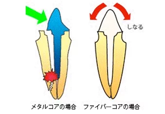 西葛西の歯医者、木村歯科医院の精密根管治療