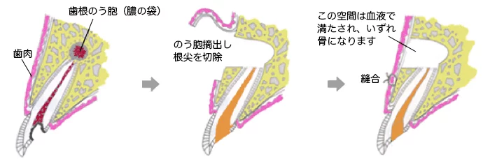 西葛西の歯医者、木村歯科医院の精密根管治療