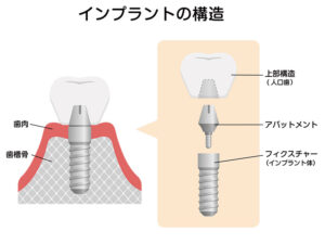 西葛西の歯医者、木村歯科医院で差し歯の解説