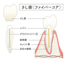 西葛西の歯医者、木村歯科医院で差し歯の解説