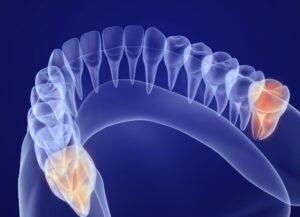 西葛西の歯医者、木村歯科医院で親知らずの抜歯