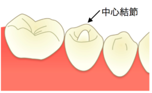 西葛西の歯医者、木村歯科医院で歯の形態異常についての解説