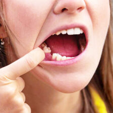 西葛西駅徒歩5分の歯医者、木村歯科医院で奥歯がないまま放置するリスクについての解説