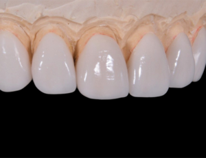 西葛西駅徒歩5分の歯医者、木村歯科医院で歯の真ん中がずれている状態のリスクについての解説