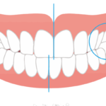 西葛西駅徒歩5分の歯医者、木村歯科医院で歯の真ん中がずれている状態のリスクについての解説
