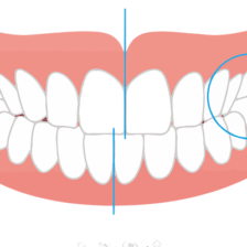 西葛西駅徒歩5分の歯医者、木村歯科医院で歯の真ん中がずれている状態のリスクについての解説