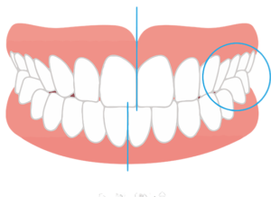 西葛西駅徒歩5分の歯医者、木村歯科医院で歯の真ん中がずれている状態のリスクについての解説