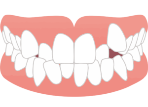 見えない裏側矯正のメリット・デメリットと適応条件を解説