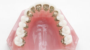 西葛西駅徒歩5分の歯医者、木村歯科医院で見えない裏側矯正のメリット・デメリットと適応条件を解説