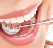 見えない裏側矯正のメリット・デメリットと適応条件を解説