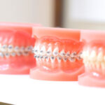 西葛西駅徒歩5分の歯医者、木村歯科医院で、矯正中にワイヤーが外れたら？外れる原因と対処法を解説
