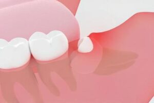 西葛西駅徒歩5分の歯医者、木村歯科医院で、歯ぐきの「特定の1か所だけ」が腫れるのはなぜ？原因や対処法を解説